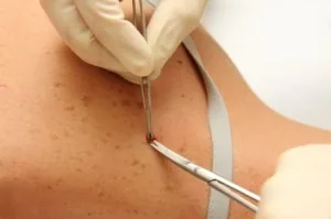 Surgical Dermatology