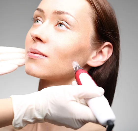 Micro-Needling with PRP