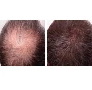PRP for Hair Loss